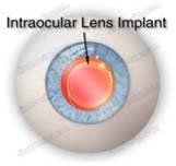 Implantable Collamer Lenses, Effective, Laser, Cataract Surgery, Cataract Surgery, Laser Eyelid Surgery